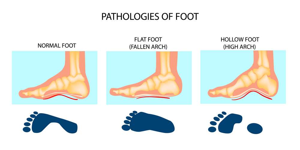 plantar-fasciitis
