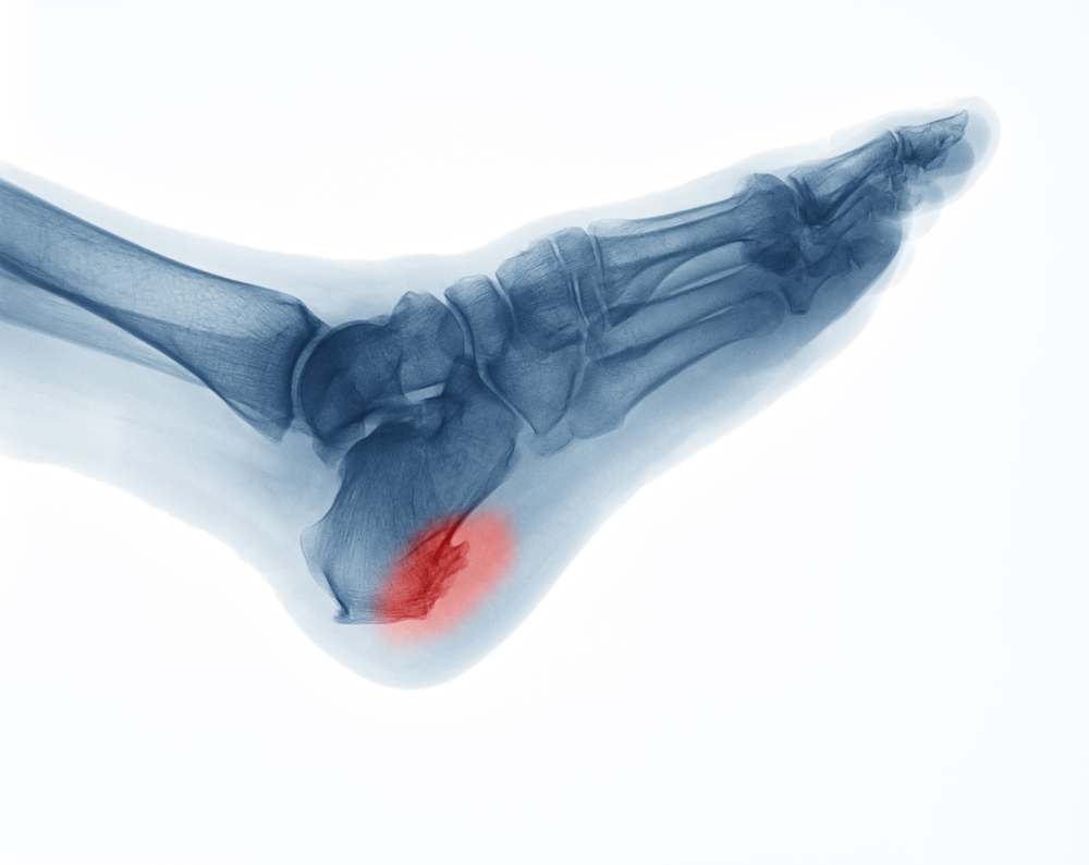 how long does plantar fasciitis take to heal