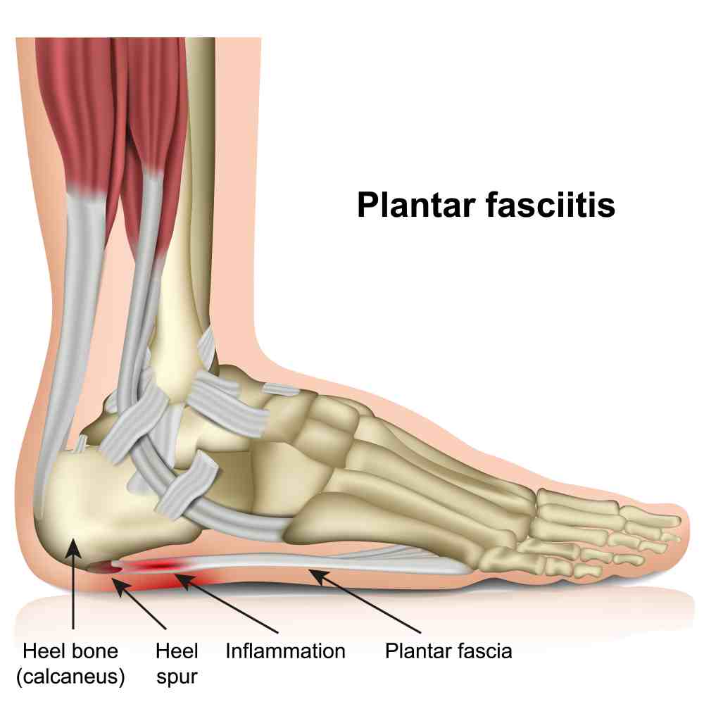 what happens if plantar fasciitis is left untreated